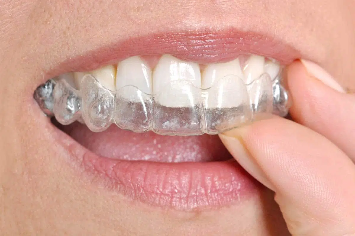 clear aligners singapore